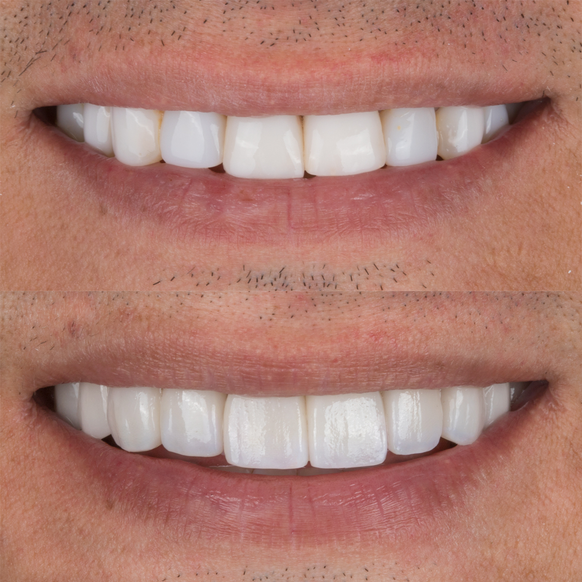 Tipos de carillas dentales, ventajas, cuidados y mantenimiento